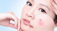 Triệu chứng và cách trị nổi mụn do nóng trong người
