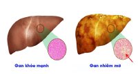 Gan nhiễm mỡ do đâu, điều trị ra sao ?