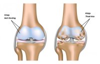 Thoái hóa sụn khớp biến chứng như thế nào?