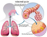 Ho do viêm phế quản khi thời tiết giao mùa phải làm sao?