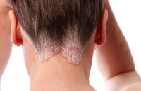 Các bệnh về da đầu thường gặp trong cuộc sống bây giờ