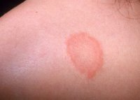 Bệnh chàm - Eczema: nguyên do, triệu chứng và cách đánh bay bệnh chàm