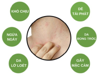 Viêm da cơ địa là gì?