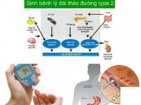 Tiểu đường tuýp 2 (type 2) là gì?