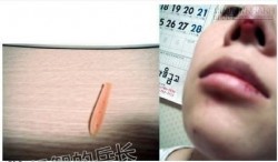 Sốc hình ảnh cô gái mọc sừng sau khi phẫu thuật nâng mũi