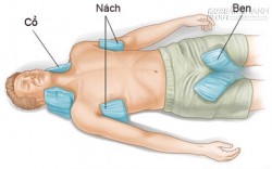 Tác hại nguy hiểm của say nắng và cách sơ cứu khi bệnh
