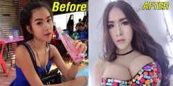 Hoảng hốt hot girl Thái Lan bơm ngực bự như 2 quả bóng