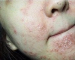 Khuôn mặt phồng rộp vì kem chống nắng