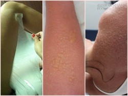 Rước hoạ vào thân vì dùng kem lột trắng da sau 1 phút