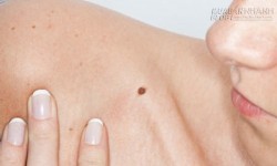 10 vị trí nốt ruồi ảnh hưởng đến vận may của bạn