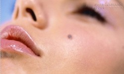 Soi nốt ruồi đoán vận may rủi