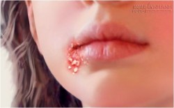 Các nguyên nhân, biến chứng và cách phòng bệnh Chốc lở