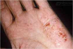 Bài thuốc nam trị dứt bệnh chàm da
