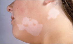 Trị tận gốc lang ben với 3 bài thuốc dân gian