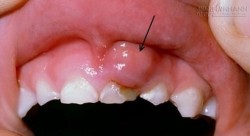 Bệnh ung thư miệng – Nguyên nhân bất ngờ