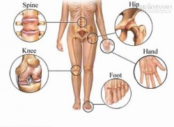 Bệnh đau khớp-Nguyên nhân và cách phòng bệnh đau khớp