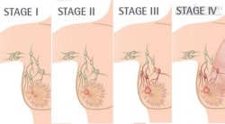 5 Bệnh ung thư thường gặp ở phụ nữ bạn phải biết