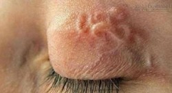 Giun sán ký sinh, ăn ruỗng phổi, mắt, đục ngực người chui ra