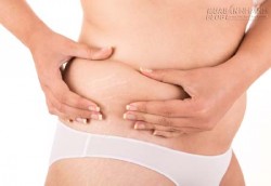 Xử lý triệt để các vết rạn da ngay tại nhà