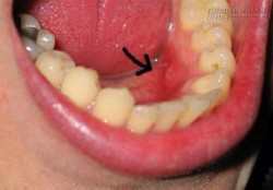Bệnh loét miệng có thể gây tử vong