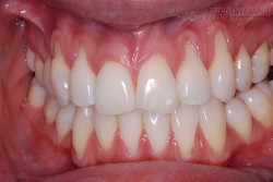 Căn bệnh dễ gây… rụng răng nhiều người mắc mà không để ý