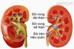 Tống sỏi thận ra ngoài nhờ 2 bài thuốc dân gian cực đơn giản