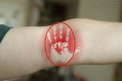 Vỗ vào lõm khuỷu tay có thể cứu mạng nạn nhân lên cơn đau tim