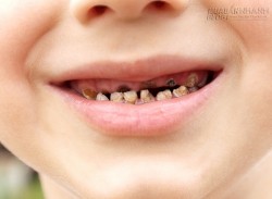 8 sai lầm kinh điển làm hỏng hàm răng xinh của bé