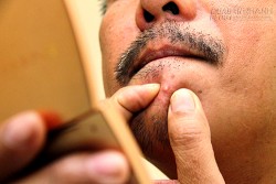 Một thanh niên chết vì nặn mụn ở Hà Nội