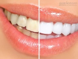 Cách chế hỗn hợp lấy cao răng siêu đơn giản tốt hơn nha sĩ