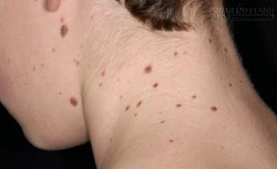 Tẩy nốt ruồi theo cách tự nhiên, an toàn chỉ trong 5 ngày thôi chị em ạ