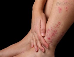 Bài thuốc tự nhiên đánh bay bệnh vảy nến trên da