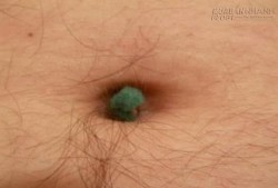 Điều gì sẽ xảy ra khi dùng móng tay móc chất bẩn ở lỗ rốn?