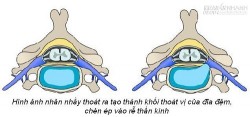 Những dấu hiệu bạn đã mắc đau thần kinh tọa hay thoát vị đĩa đệm