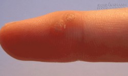 Mẹo chữa mụn cóc đơn giản và hiệu quả ngay tức khắc