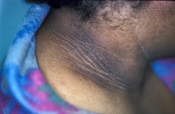 Chưa biết cách trị thâm đen cổ, nhất định phải đọc bài viết này