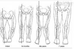 Nguyên nhân và cách chữa chân vòng kiềng ở trẻ nhỏ