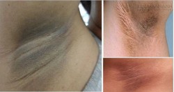 Công thức tự nhiên trị thâm nách hiệu quả 100%