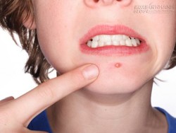 Bí kíp hô biến đốm mụn xấu xí chỉ sau 1 đêm