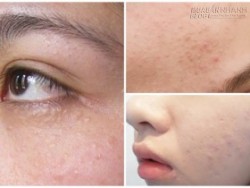 Đi tìm nguyên nhân và cách trị hoàn toàn mụn ẩn, mụn chìm li ti