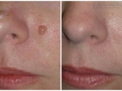 5 cách hiệu quả để tạm biệt nốt ruồi xấu xí trên mặt