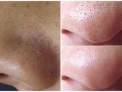 Tự chế hỗn hợp lột đến đâu, mụn đầu đen bay tới đấy