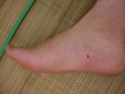 Những tiết lộ từ vị trí nốt ruồi ở chân ai cũng phải biết