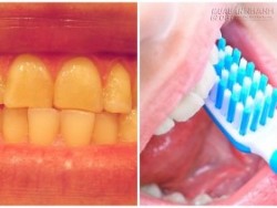 5 thói quen lười biếng âm thầm phá hỏng hàm răng