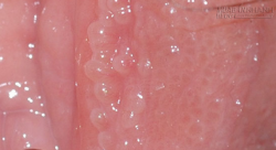 Tái mặt, hoảng hồn: Sao sùi mào gà lại dễ lây đến thế?