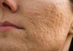 Cách dưới đây tống cổ sẹo rỗ cần gì đi thẩm mỹ viện