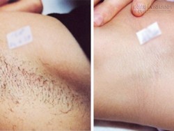 Công thức tẩy lông siêu tốc chỉ trong 5 phút