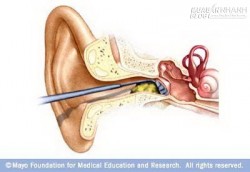 7 bí quyết loại bỏ ráy tai an toàn, không hề đau