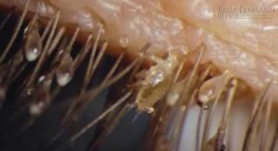 Rận mu liên tục tấn công người Hà Nội