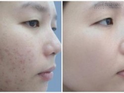 Tạm biệt vết thâm mụn trong 7 ngày với những phương pháp rẻ bèo